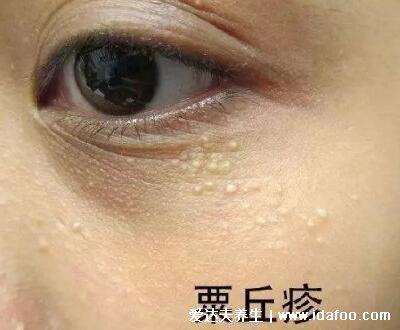 扁平疣和脂肪粒的区别图片，扁平疣是圆形隆起丘疹(青少年易得)