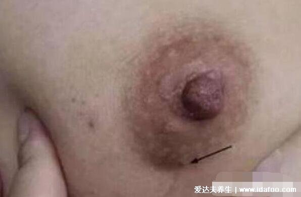 乳腺癌图片大全早期症状真人,乳房有肿块皮肤凹陷时要及时诊治
