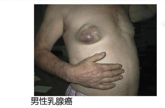 乳腺癌图片大全早期症状真人,乳房有肿块皮肤凹陷时要及时诊治