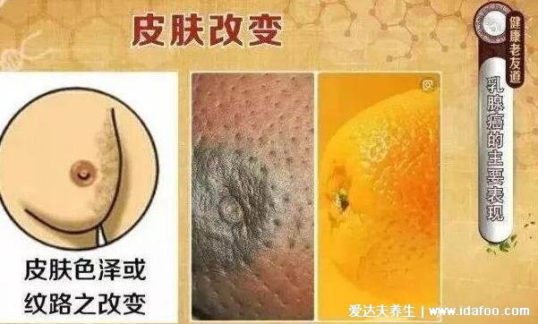 乳腺癌图片大全早期症状真人,乳房有肿块皮肤凹陷时要及时诊治