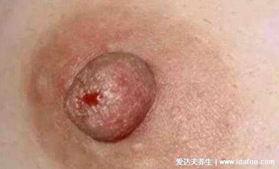 乳腺癌图片大全早期症状真人,乳房有肿块皮肤凹陷时要及时诊治