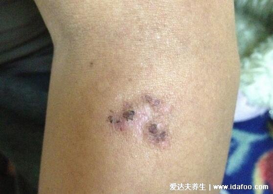 人感染皮肤炭疽病有多可怕,肺炭疽从发病到死亡只有两天(图片)