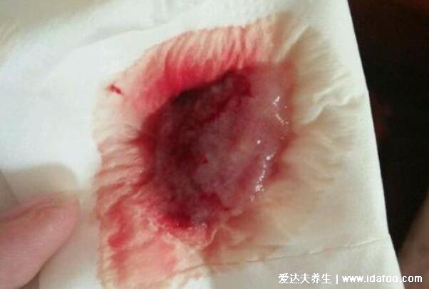 药流的最佳时间是多少天做，停经后35-49天内年龄34岁以下
