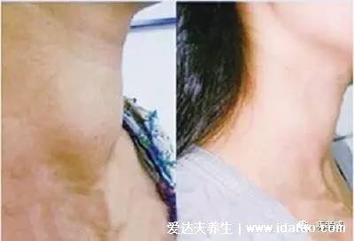 脖子淋巴癌早期症状图片,淋巴结肿大无痛感光滑(有发热消瘦现象)