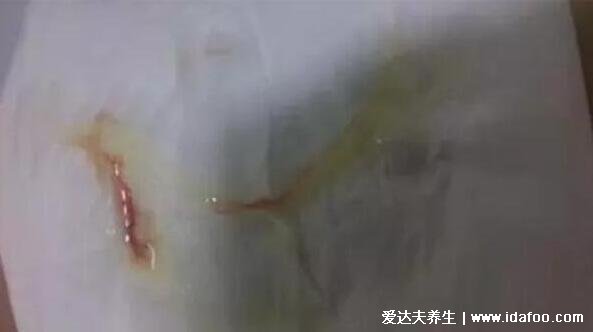 hpv疫苗接种禁忌症和注意事项,10种情况不能打宫颈癌疫苗