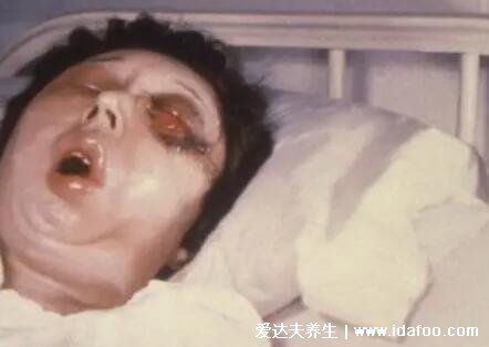 人体感染炭疽病图片人图片是什么病,皮肤炭疽多见(炭疽4种类型)