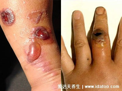 人体感染炭疽病图片人图片是什么病,皮肤炭疽多见(炭疽4种类型)