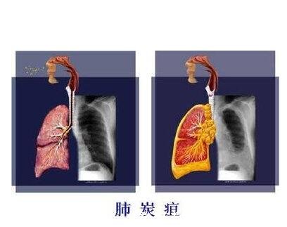 人体感染炭疽病图片人图片是什么病,皮肤炭疽多见(炭疽4种类型)