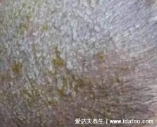 婴儿奶藓图片长什么样子,头面部有红疹还