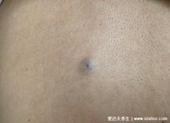 皮脂腺囊肿图片初期症状图片,光滑肿物不