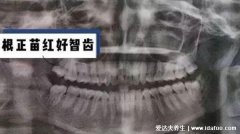 智齿有必要拔吗，看清不需要拔的智齿图片