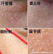扁平疣和脂肪粒的区别图片，扁平疣是圆形