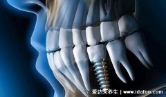 种植牙有什么风险和后遗症，手术过程有风