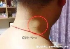 脖子淋巴癌早期症状图片，淋巴结肿大无痛