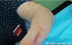 人体感染炭疽病图片人图片是什么病,皮肤