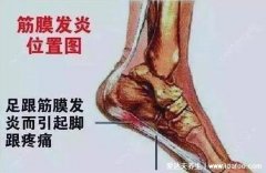 3个足底筋膜炎痛点图片，经常脚后跟疼的注
