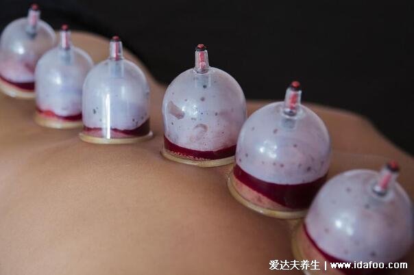 拔罐后多长时间可以洗澡,3小时内不能洗附拔罐后注意事项