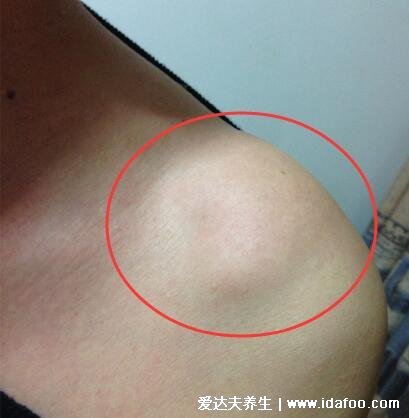 皮瘤长什么样子图片,初期皮下脂肪瘤图片及症状