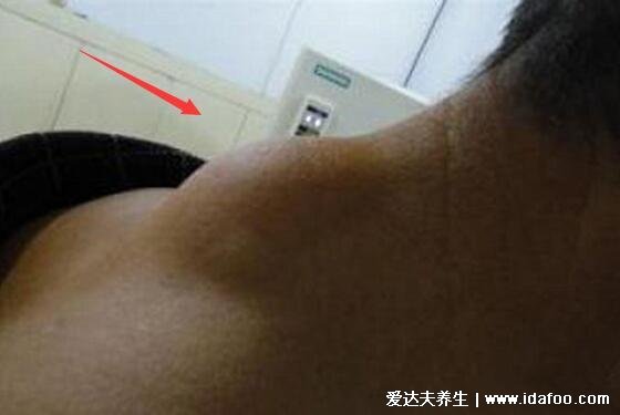 皮瘤长什么样子图片,初期皮下脂肪瘤图片及症状