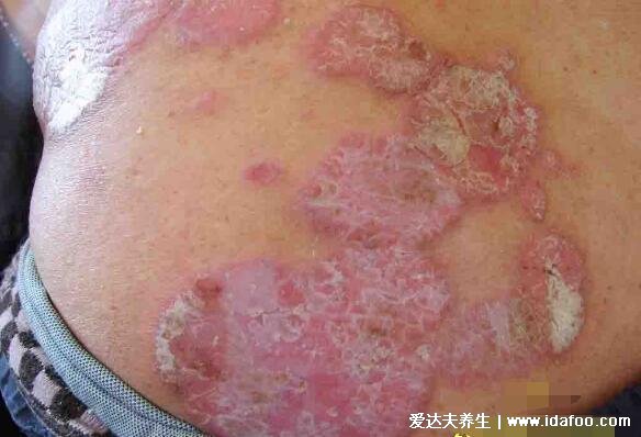 各种常见真菌皮肤病图片及症状对照大全,看图看自己(胆小慎点)