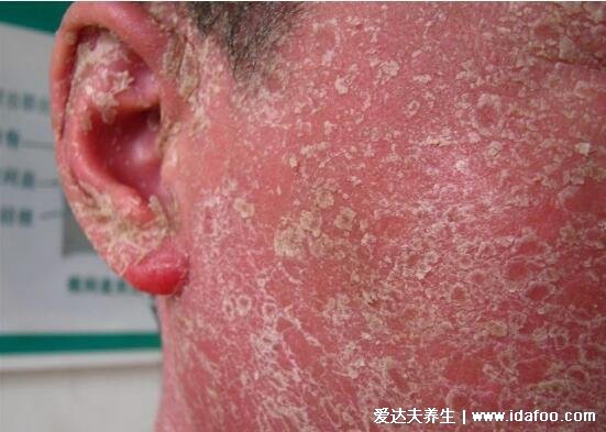 各种常见真菌皮肤病图片及症状对照大全,看图看自己(胆小慎点)