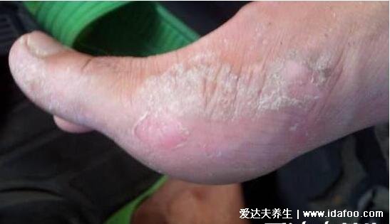 各种常见真菌皮肤病图片及症状对照大全,看图看自己(胆小慎点)
