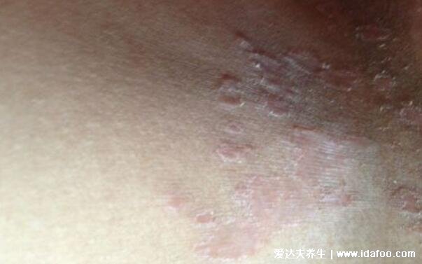 各种常见真菌皮肤病图片及症状对照大全,看图看自己(胆小慎点)