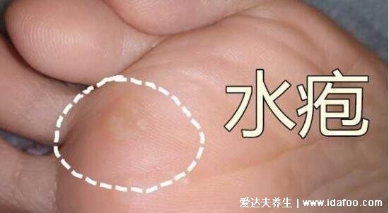 各种常见真菌皮肤病图片及症状对照大全,看图看自己(胆小慎点)