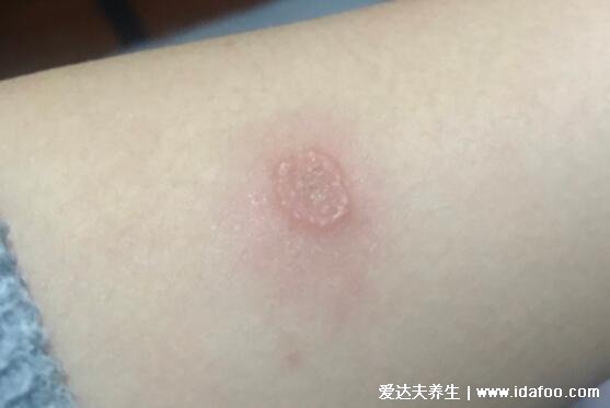 各种常见真菌皮肤病图片及症状对照大全,看图看自己(胆小慎点)