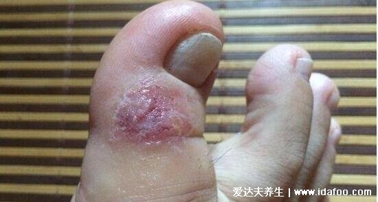 各种常见真菌皮肤病图片及症状对照大全,看图看自己(胆小慎点)