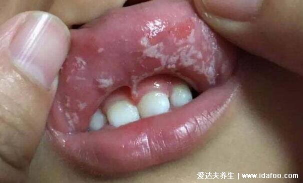 各种常见真菌皮肤病图片及症状对照大全,看图看自己(胆小慎点)