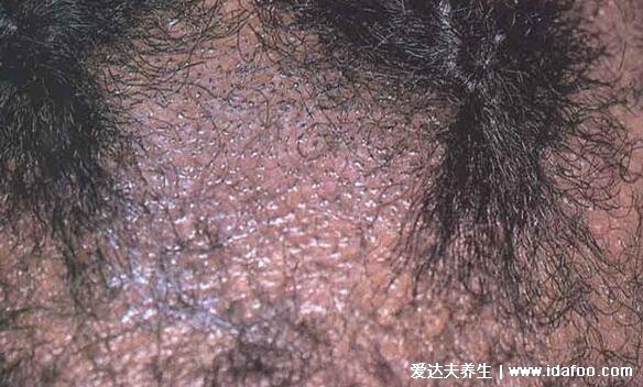 各种常见真菌皮肤病图片及症状对照大全,看图看自己(胆小慎点)