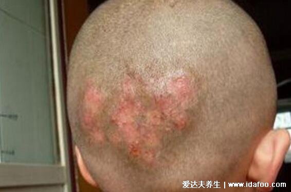 各种常见真菌皮肤病图片及症状对照大全,看图看自己(胆小慎点)