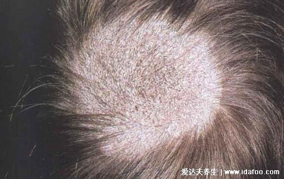 各种常见真菌皮肤病图片及症状对照大全，看图看自己(胆小慎点)
