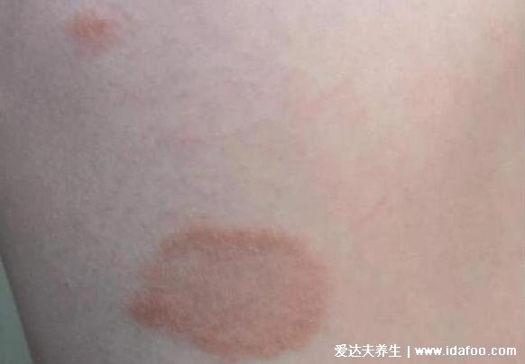 100种皮肤病对照表，各种皮肤病对照图片大全及症状