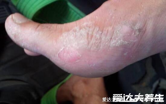 100种皮肤病对照表，各种皮肤病对照图片大全及症状