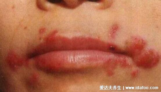 100种皮肤病对照表，各种皮肤病对照图片大全及症状