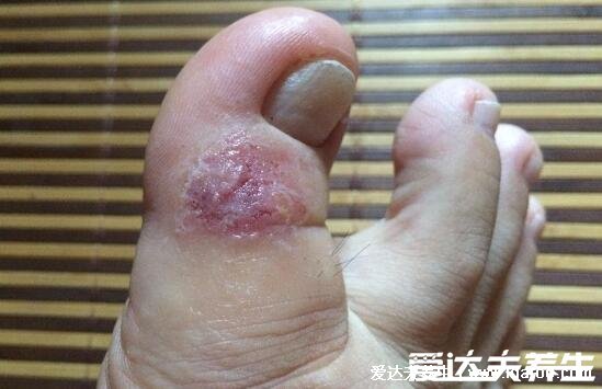 100种皮肤病对照表，各种皮肤病对照图片大全及症状