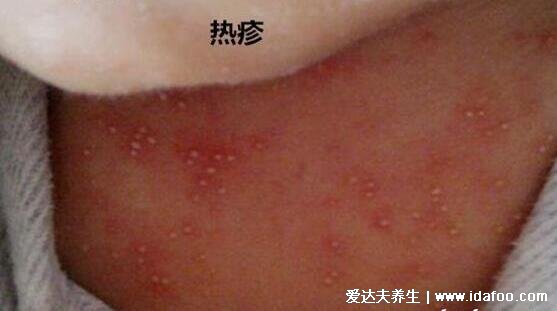 100种皮肤病对照表，各种皮肤病对照图片大全及症状