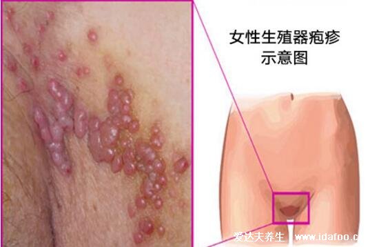 早期生殖疱疹的症状和治疗，长水疱伴随瘙痒疼痛(附男女图片)