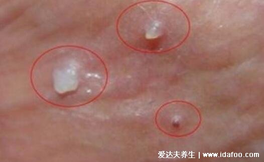 早期生殖疱疹的症状和治疗，长水疱伴随瘙痒疼痛(附男女图片)