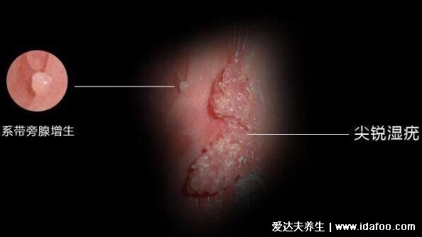 尖锐湿尤图症状图片男,柔软的小疙瘩会相互融合成菜花状