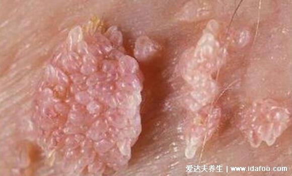 尖锐湿尤图症状图片男,柔软的小疙瘩会相互融合成菜花状