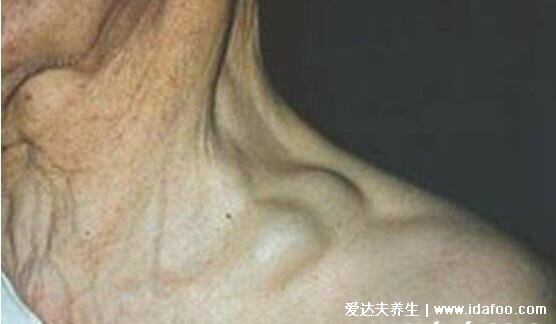 脖子淋巴癌早期图片及症状,能明显摸到质地坚硬的肿块不痛不痒
