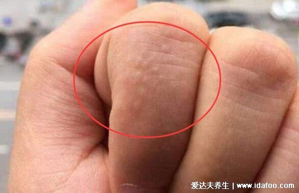 手上长水泡湿疹的图片,密集的小水泡伴随剧烈瘙痒(附祛湿法)