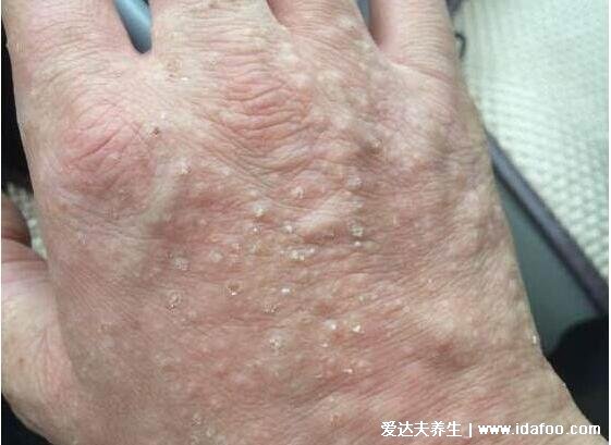 手上长水泡湿疹的图片,密集的小水泡伴随剧烈瘙痒(附祛湿法)