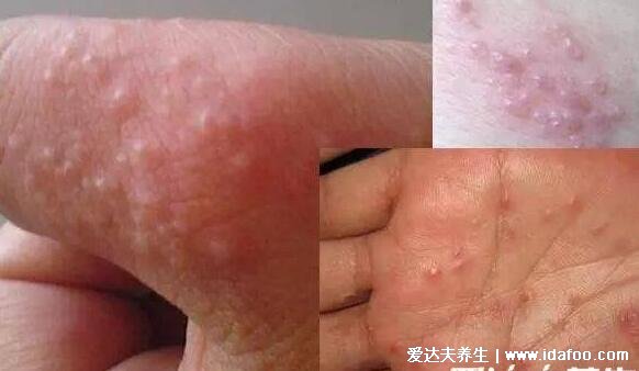手上长水泡湿疹的图片,密集的小水泡伴随剧烈瘙痒(附祛湿法)