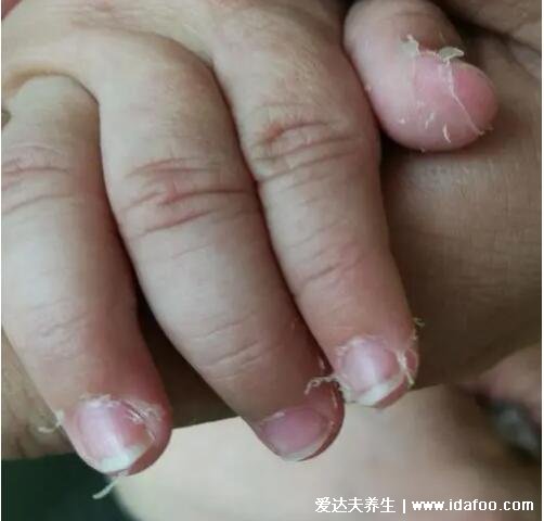 孩子得了川崎病我崩溃了,可能有严重心血管并发症(6大症状)