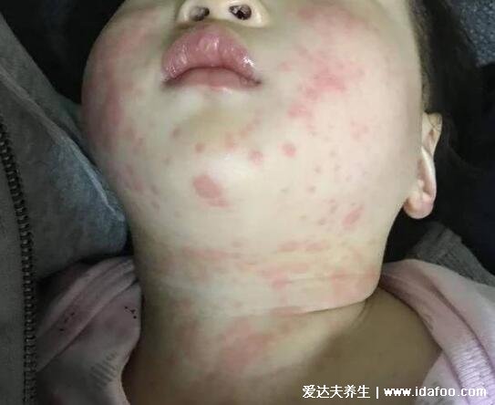 孩子得了川崎病我崩溃了,可能有严重心血管并发症(6大症状)