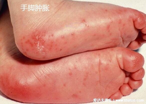 孩子得了川崎病我崩溃了,可能有严重心血管并发症(6大症状)
